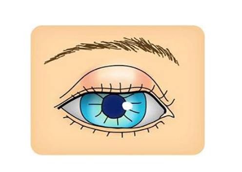 眼睛麥粒腫初期