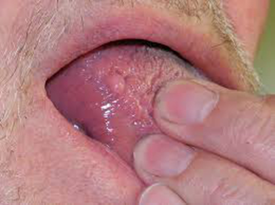 口腔癌的前兆 (9) 