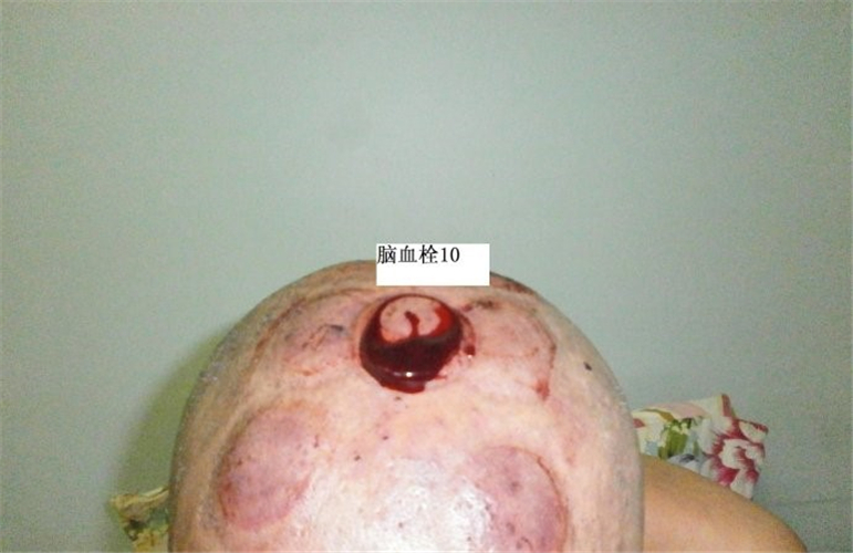 腦血栓中醫治療什麼樣