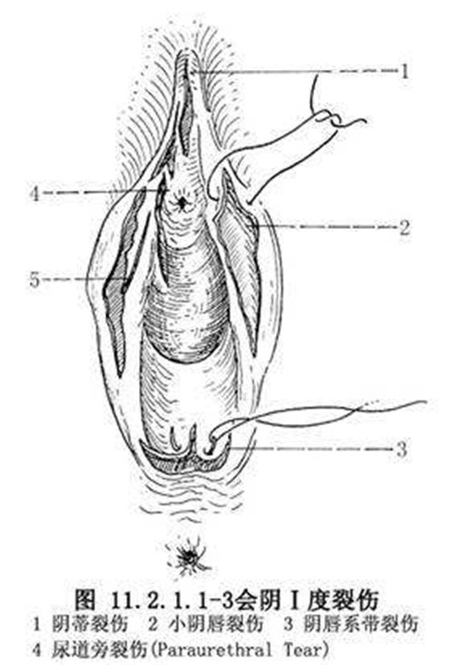 一度會陰撕裂修復