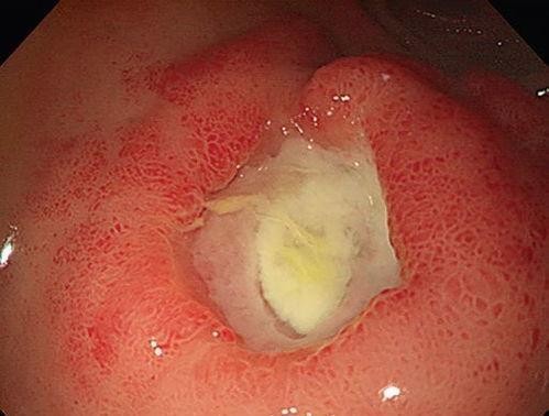 十二指腸潰瘍的症狀及治療 (47) 