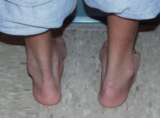 腳骨頭突出 (37) 