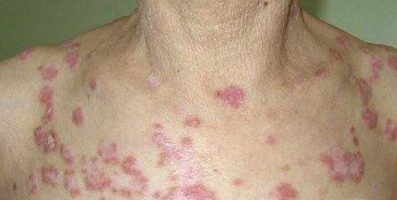 紅斑結節圖 (58) 