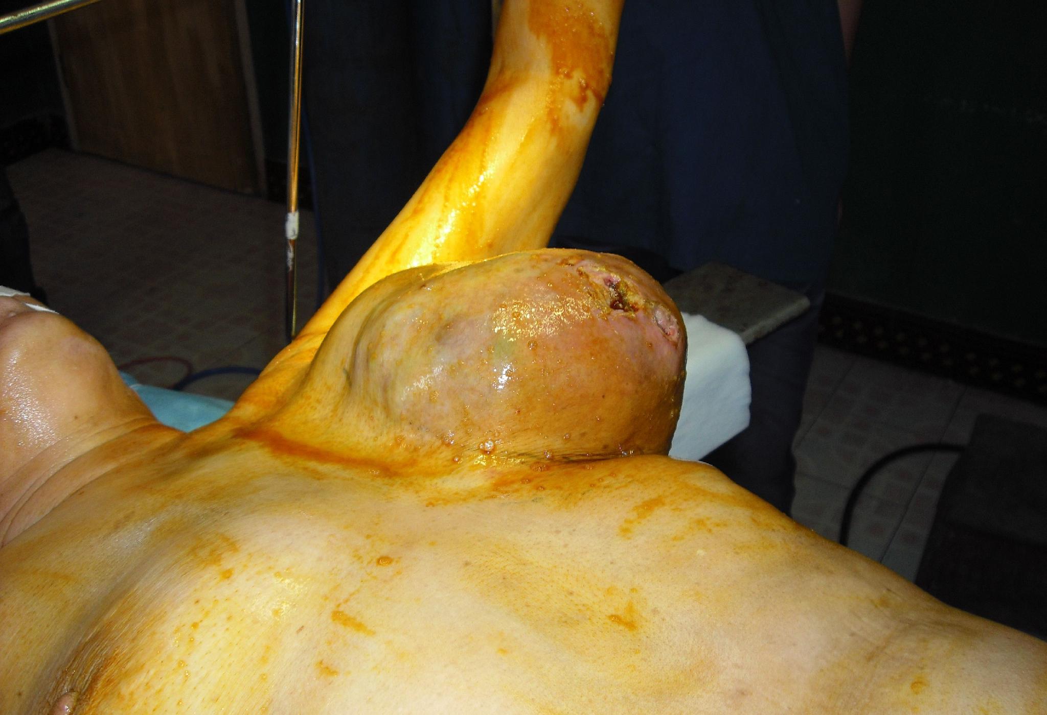 晚期乳腺纖維瘤