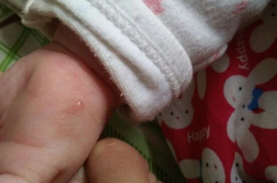 寶寶手上長水泡