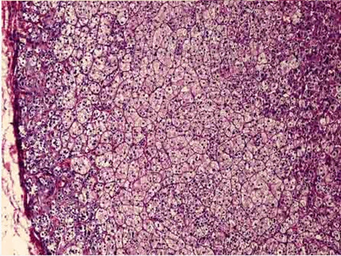 高分化肺腺癌鏡下