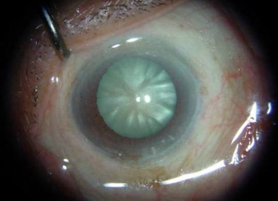 白內障的早期症狀