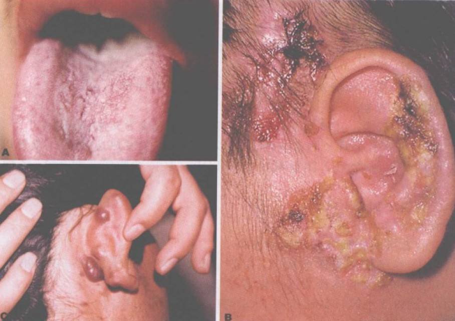 中醫 傳染性軟疣 