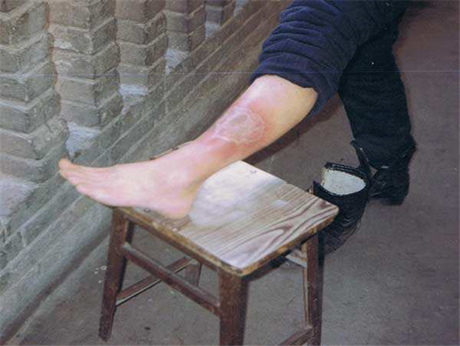 左小腿血栓性靜脈炎