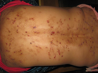 結節性癢疹 (30) 