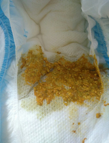 新生兒消化不良大便圖 (68) 