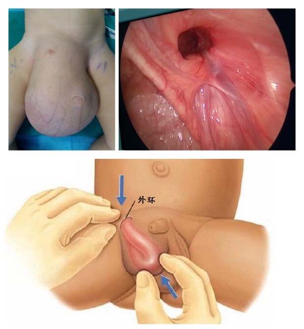 小兒鞘膜積液 (44) 