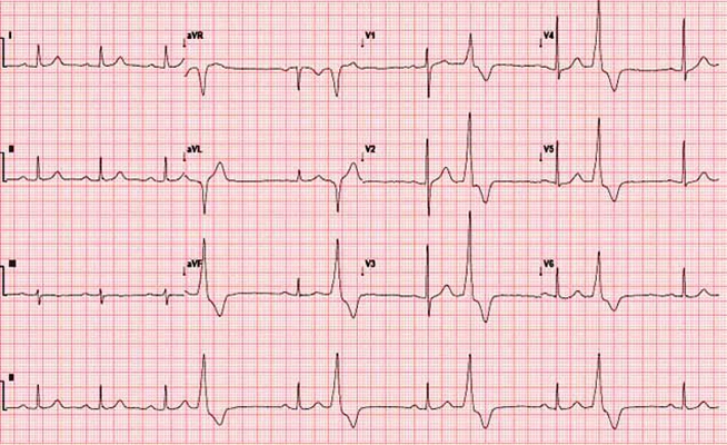 房顫心電圖特點 (59) 