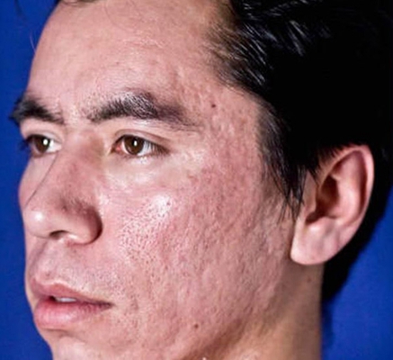 激素臉排毒症狀 (4) 