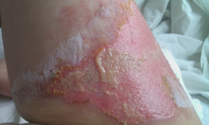 深二度燒傷 (38) 