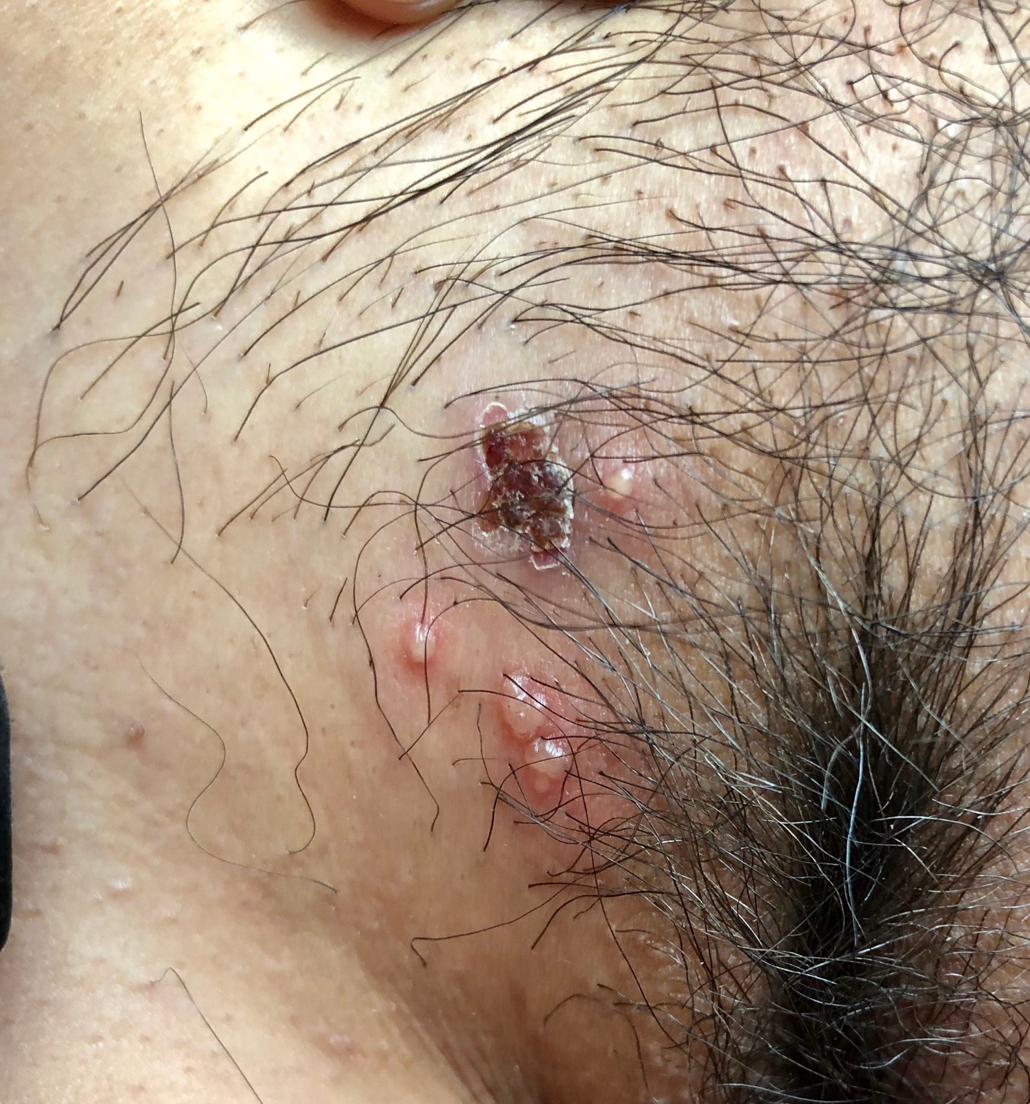 女性生殖器皰疹 (8) 