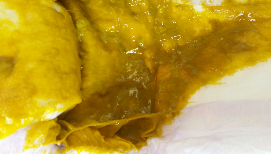 新生兒腹瀉大便